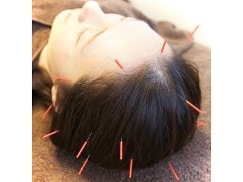 『【頭痛・腰痛専門】宇多津 鍼灸院 SHIMADA』「その痛み」、諦めないで!! 頭痛と腰痛を中心に特化した「痛みと不調」の専門鍼灸院【香川県綾歌郡宇多津町】