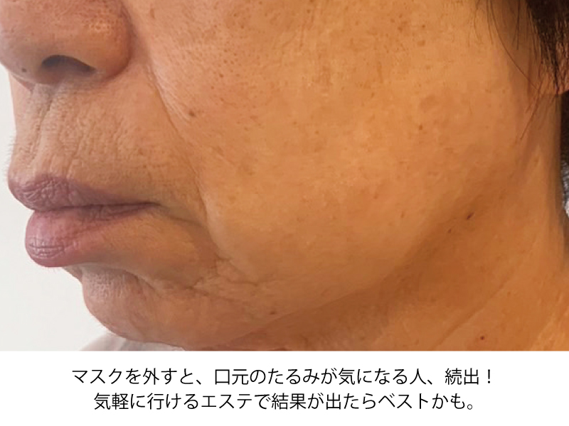 シミ・シワ・たるみ まだあきらめないで！今すぐGo