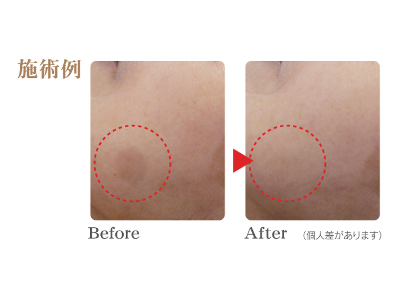 自分の顔をもっと好きになる!しわ･シミにアプローチする2つの新メニュー！