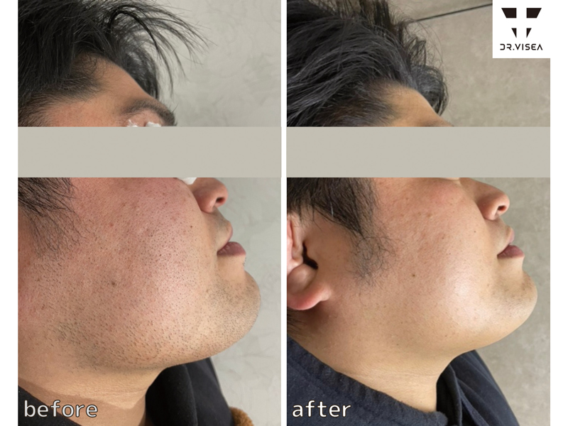 『都度払い脱毛サロン fenice フェニーチェ』忙しいあなたにぴったり！都度払い×深夜営業で通いやすい、今注目のLED脱毛サロン。【香川県高松市古馬場町　