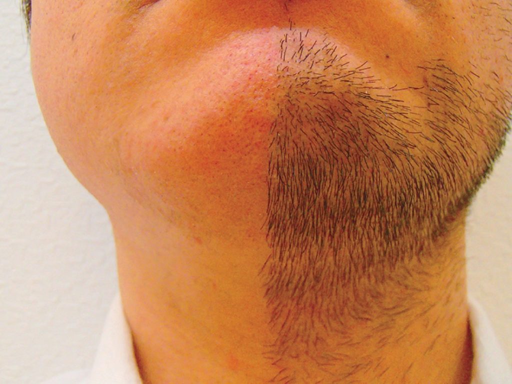 メンズに特化したサービスと脱毛機で安心