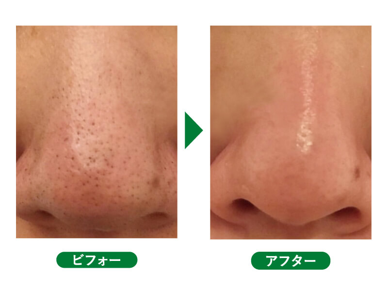 マスクを取る前に、定額制でお得に「つるつるお鼻」 と 「ハリ美肌」 を手に入れちゃおう！